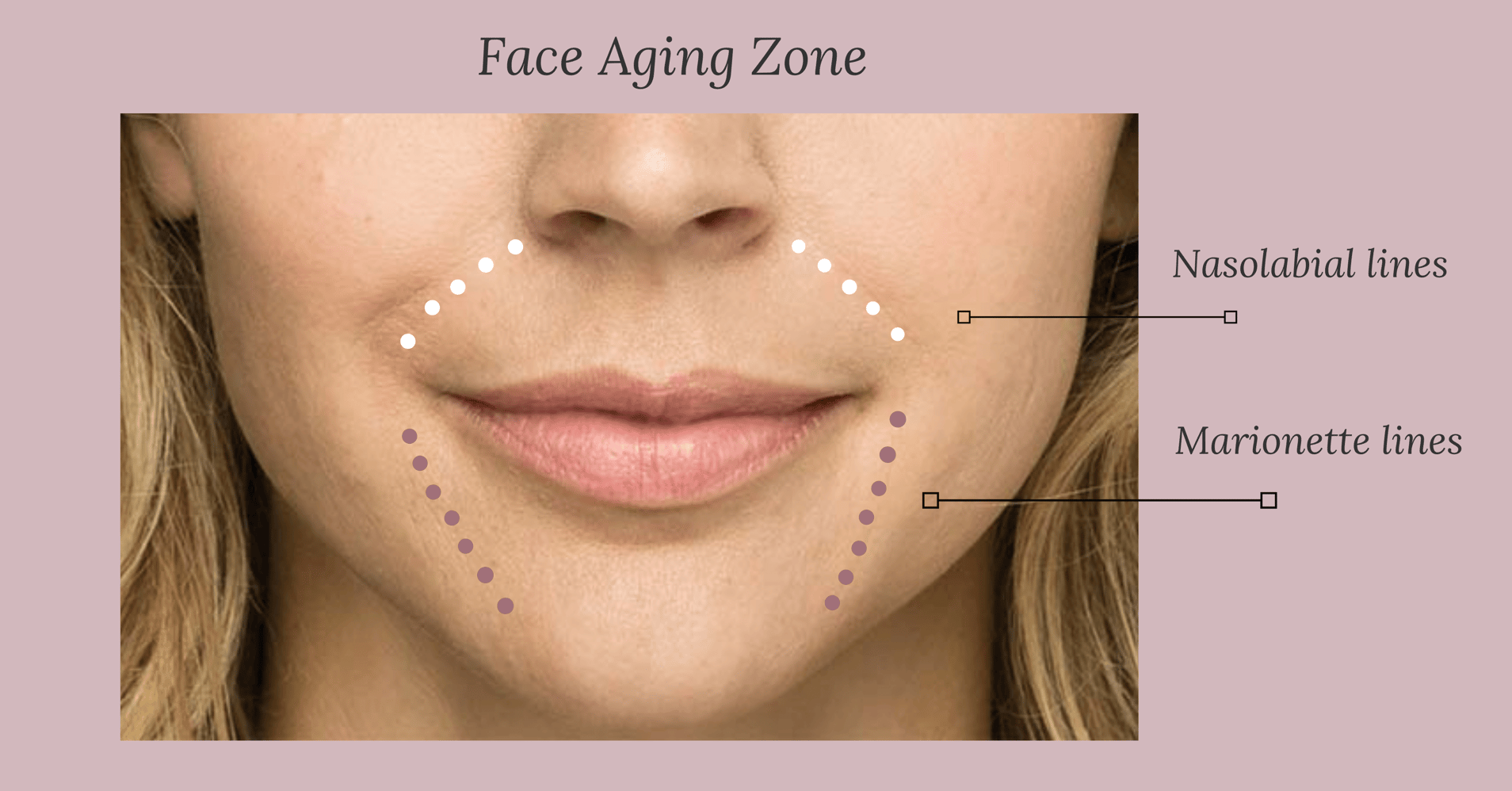 How Do Nasolabial Lines Form And What Can We Do To Fight Them